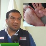 Aumentan casos de virus coxsackie en Huaral.