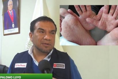 Aumentan casos de virus coxsackie en Huaral.