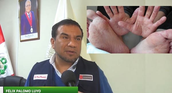 Aumentan casos de virus coxsackie en Huaral.