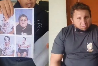 Hombre pide justicia tras quedar desfigurado luego de sufrir accidente en mototaxi.